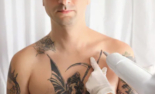 Tattoo removal 